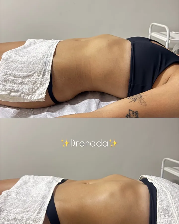 Antes e depois de drenagem linfática na barriga